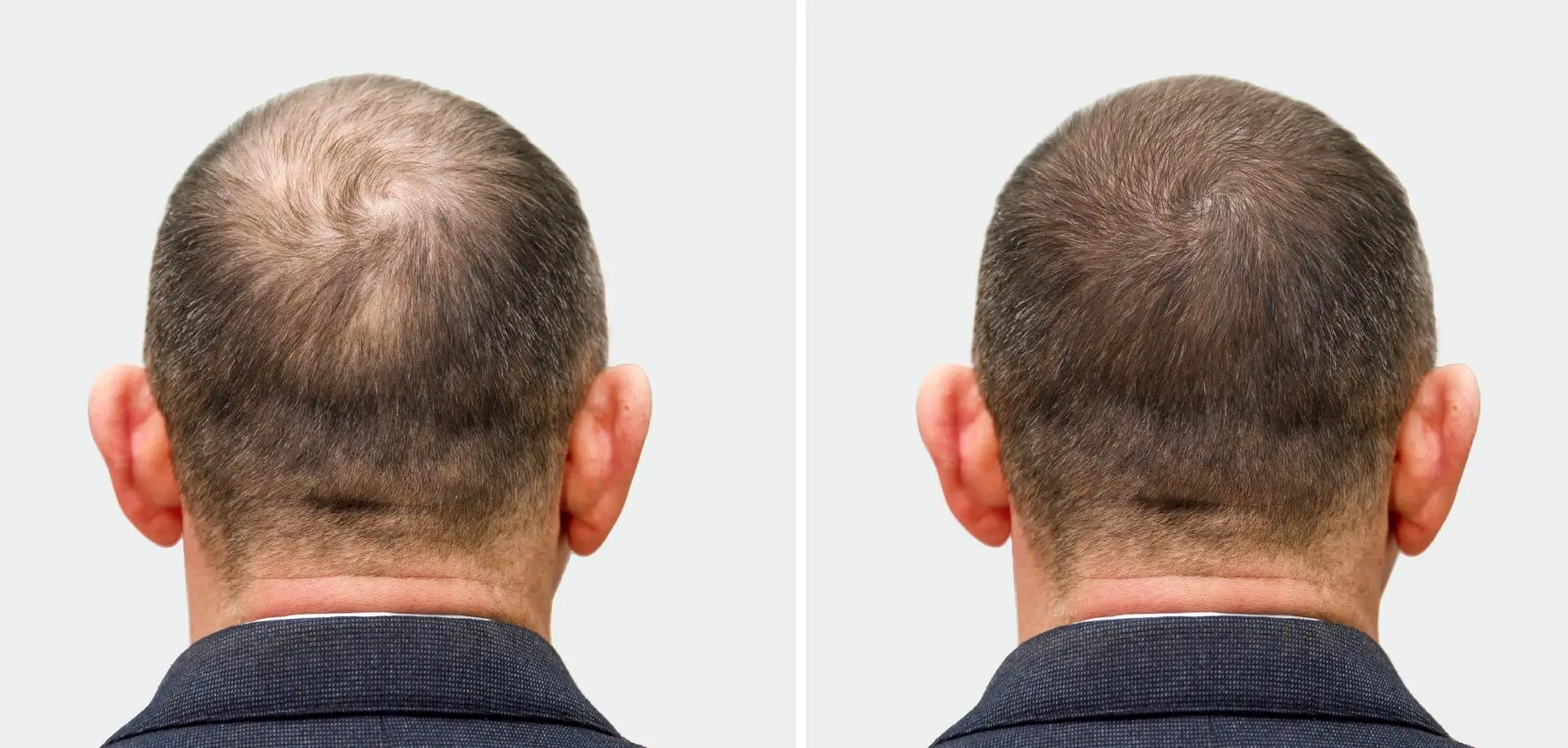 Custom Men’s Hair Systems in New York City